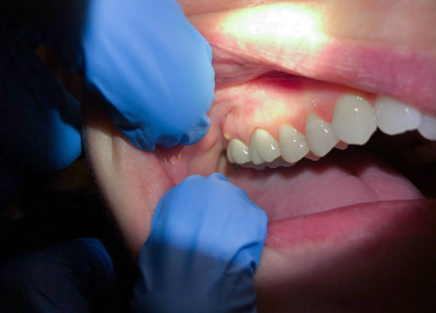 Best Knocked-Out Tooth Emergency  in Rancho Murieta, CA